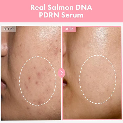 Complex Peptide Acne Serum PDRN Collagen Shrink Pores Fade Melanin Smooth Brightening Skin Korean Skincare Products